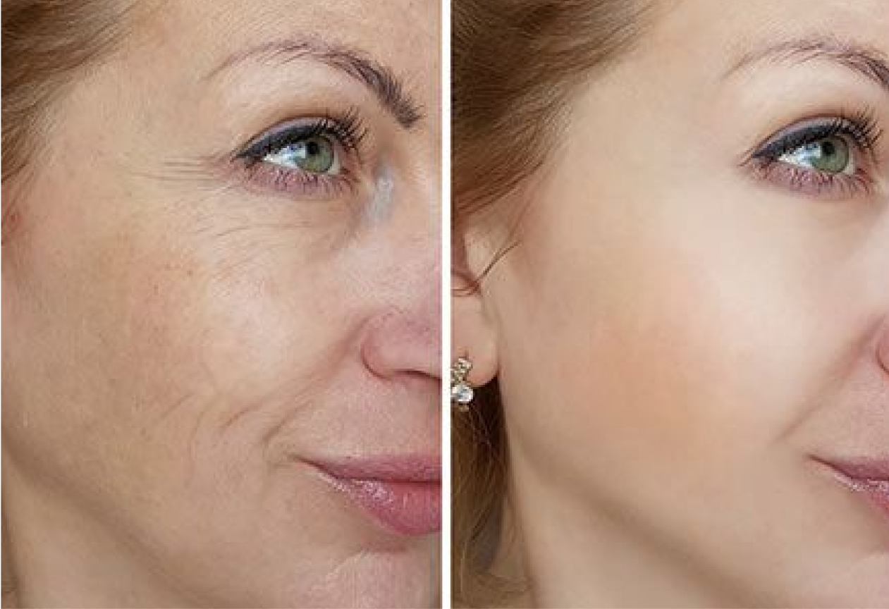 MicroSculpt – My Derma Dream UK